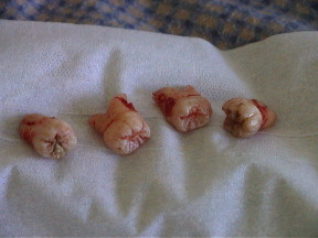 Sarah's wisdom teeth